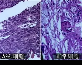 挑战癌症的生死之谜